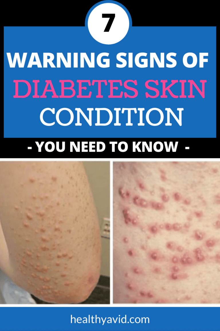 7 Diabetes Skin Problems And Warning Signs You Should Know 7313
