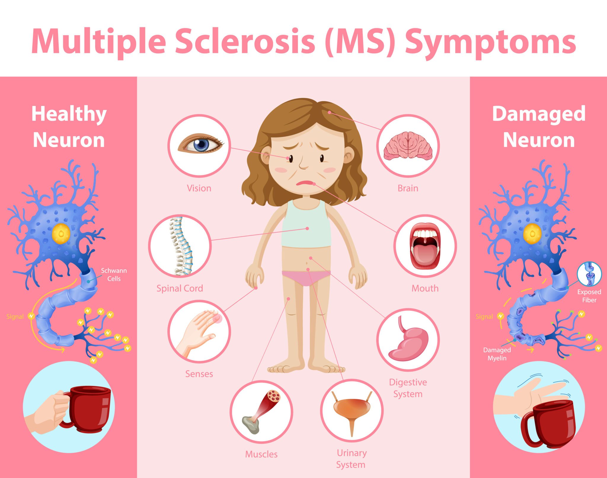 Early Signs and Symptoms of MS (Multiple Sclerosis)