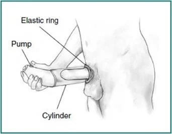 PENIS PUMP FOR ED